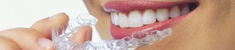 Ortodonzia: Invisalign, l’apparecchio invisibile.